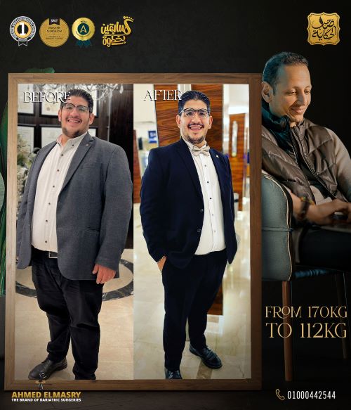 النظام الغذائي بعد التكميم